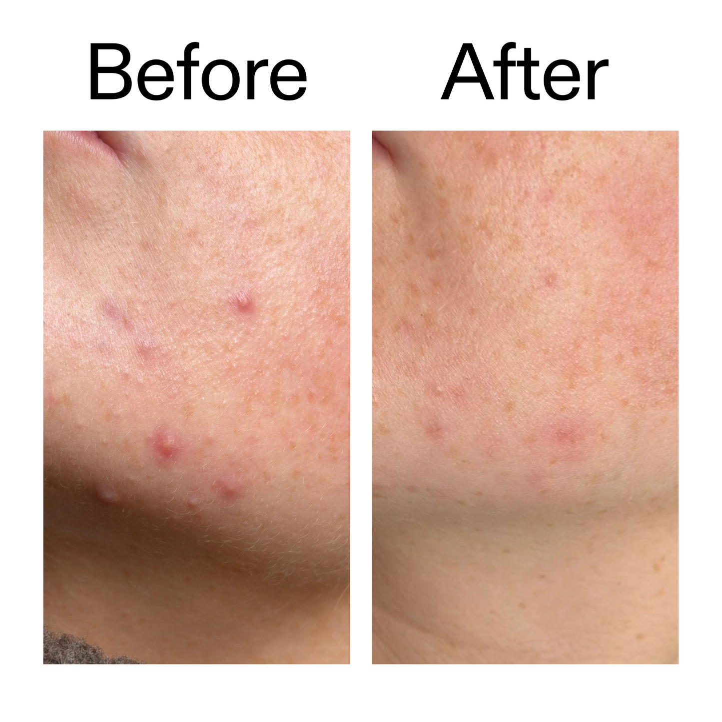 10-azelaic-acid-serum-for-redness-relief-s9 B_A_1_PPAGE.png