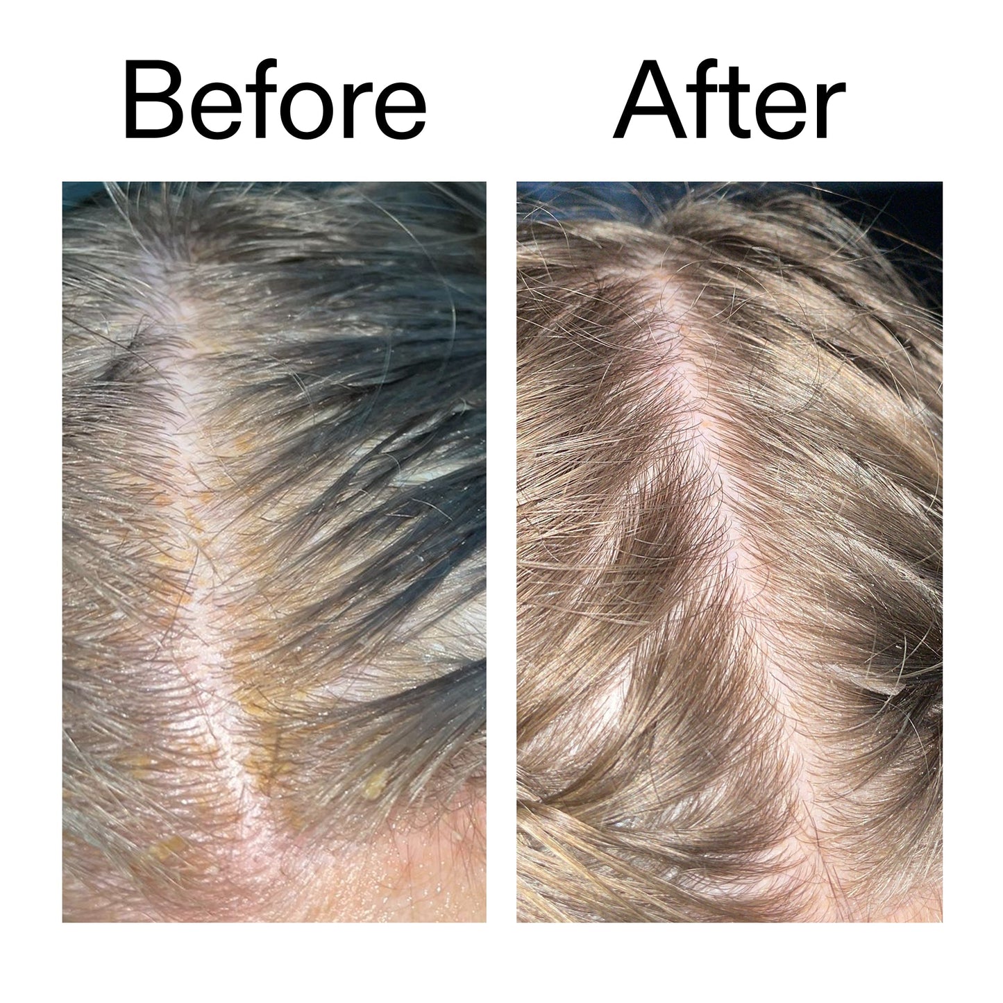 salicylic-acid-exfoliating-scalp-treatment-d7 Salicylic_Acid_Exfoliating_Scalp_Treatment_Before_After_2000x2000_e572a30f-057c-4a48-823b-1c09dc97f8d0.jpg