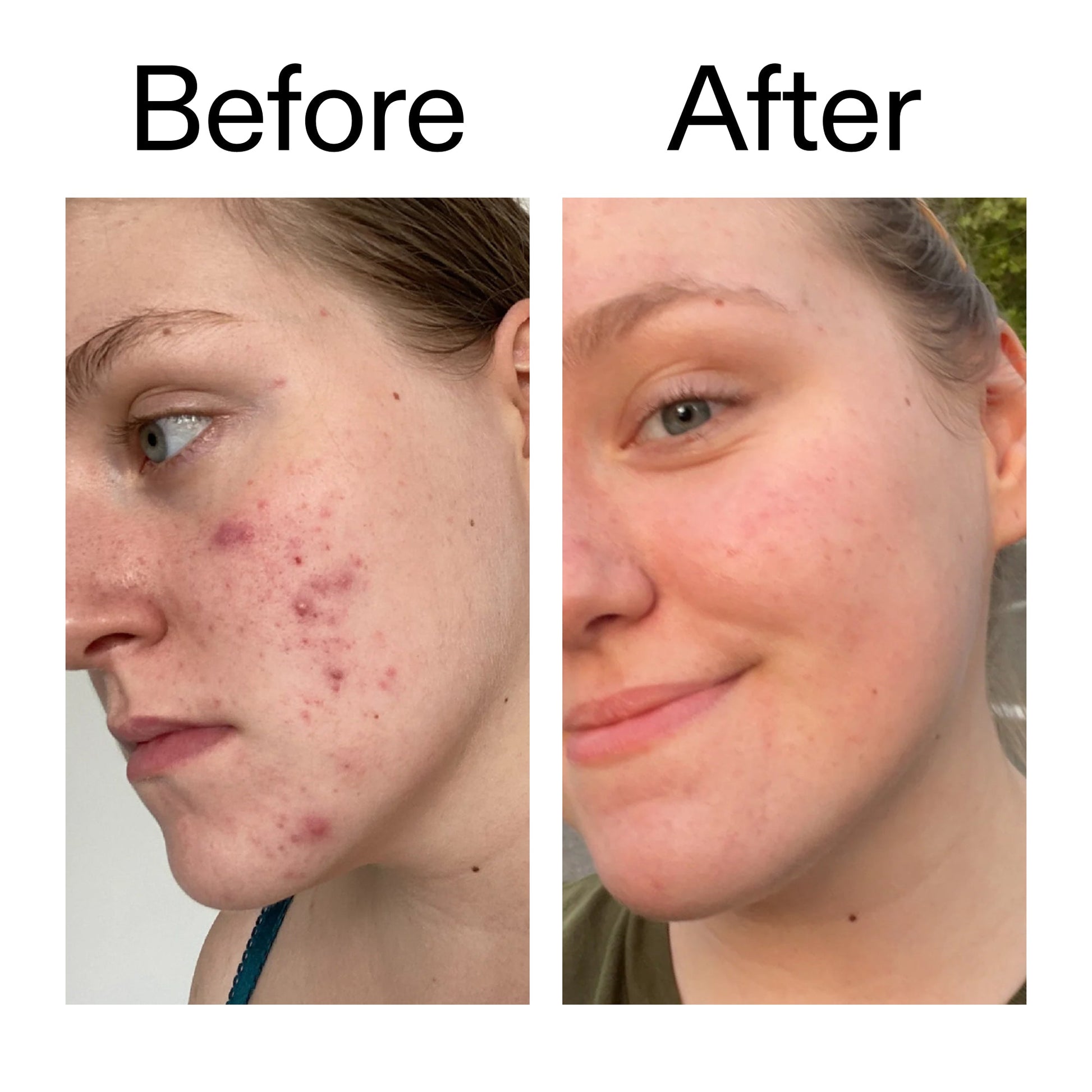 15-vitamin-c-egf-serum-y6 15_Vitamin_C_EGF_Serum_Before_After_2000x2000_fb9f598a-3386-40c8-8143-36f9d7a17ec8.jpg