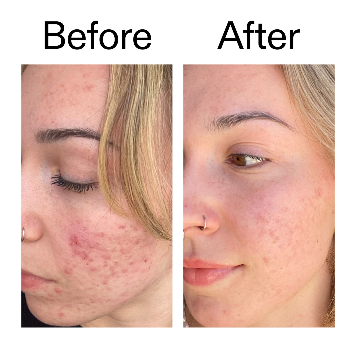 10-azelaic-acid-serum-for-redness-relief-s9 B_A_2_PPAGE.png