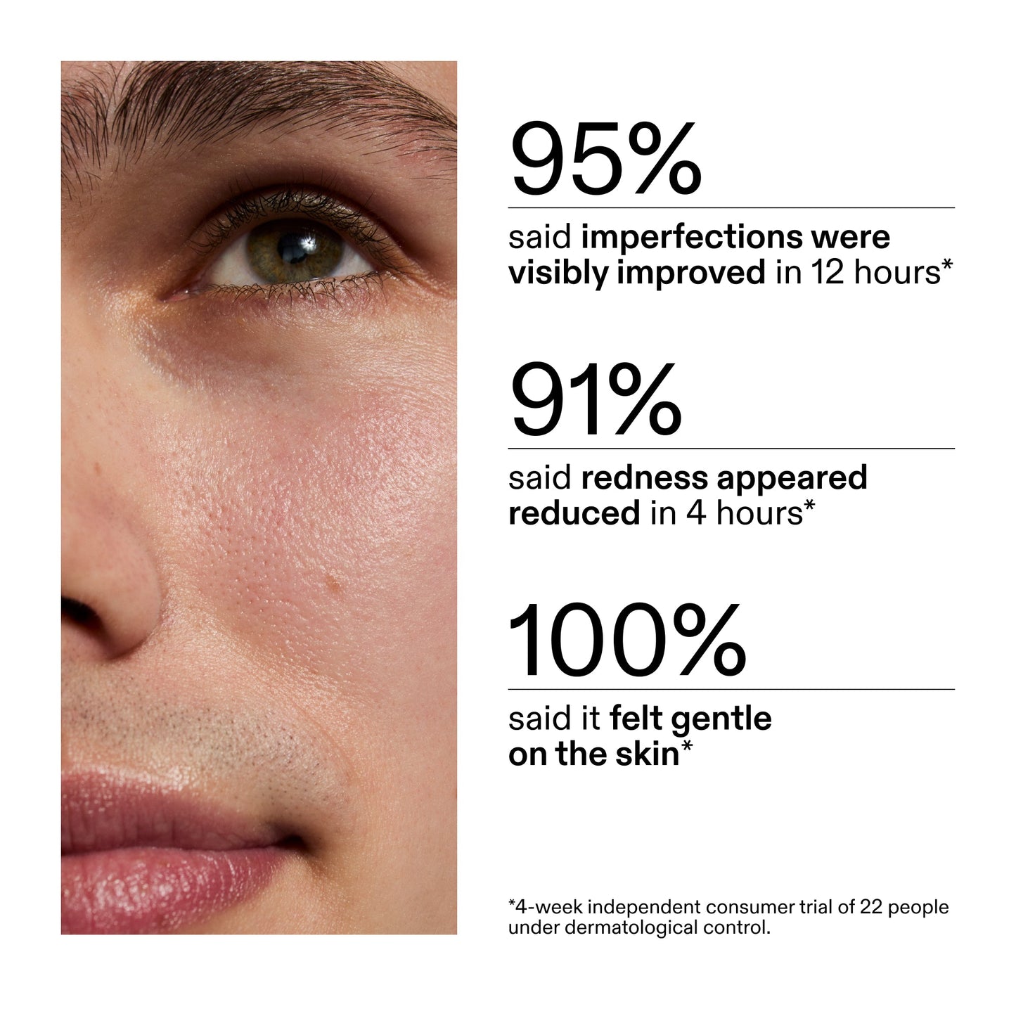 succinic-acid-acne-treatment-y3 CA_Succinic_Acid_Treatment_key_Claims_2000x2000_db91b0f1-7f29-4bfe-bb16-63a47f500960.jpg