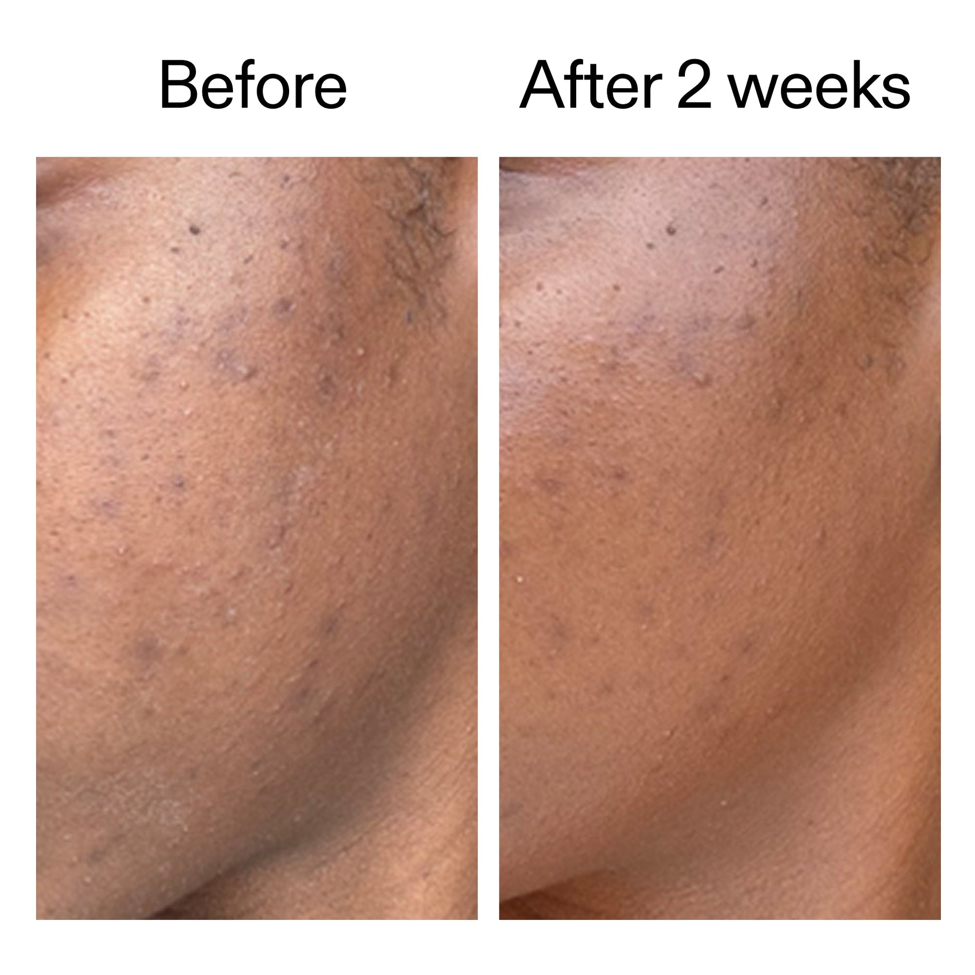 360-acne-clearing-duo-n9 DIOICB_A2000x2000.jpg
