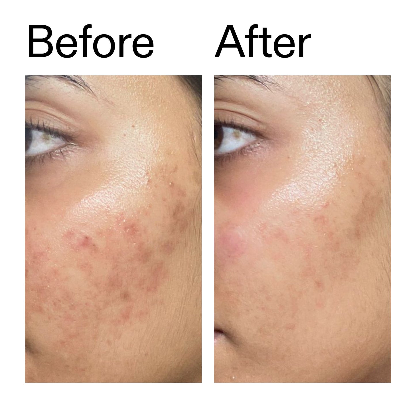 ectoin-hydro-barrier-serum-duo-j1 Ectoin_Hydro-barrier_Serum__Before_After_2000x2000_34261920-d004-48d0-9c7b-8e1c15971bfd.jpg