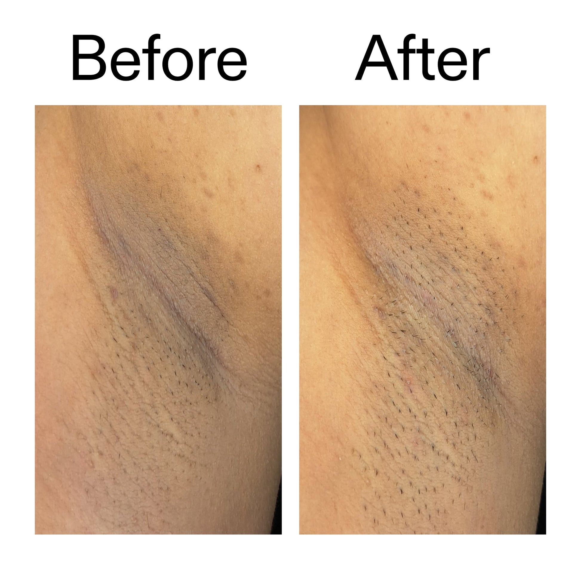 glycolic-acid-exfoliating-body-stick-duo-k6 Glycolic_Acid_Exfoliating_Body_Stick_Before_After_V3_2000x2000_ea919cd9-1439-4a46-82a0-76200eb5bb42.jpg