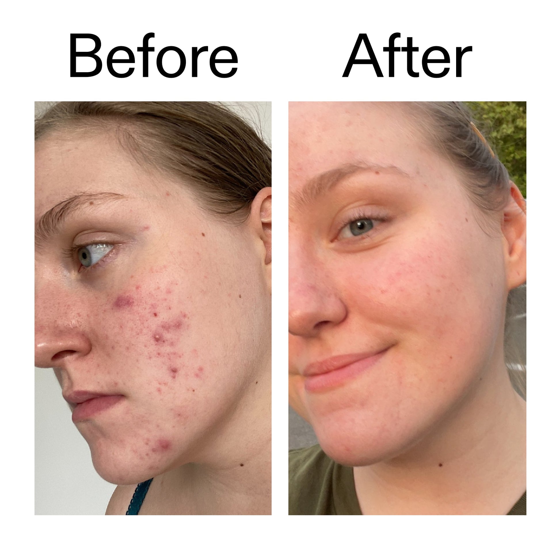 glycolic-acid-toner-i1 Glycolic_Acid_Toner_Before_After_2000x2000_49f0b9f7-e71b-4b2e-a8f8-2ea4b73247bb.jpg