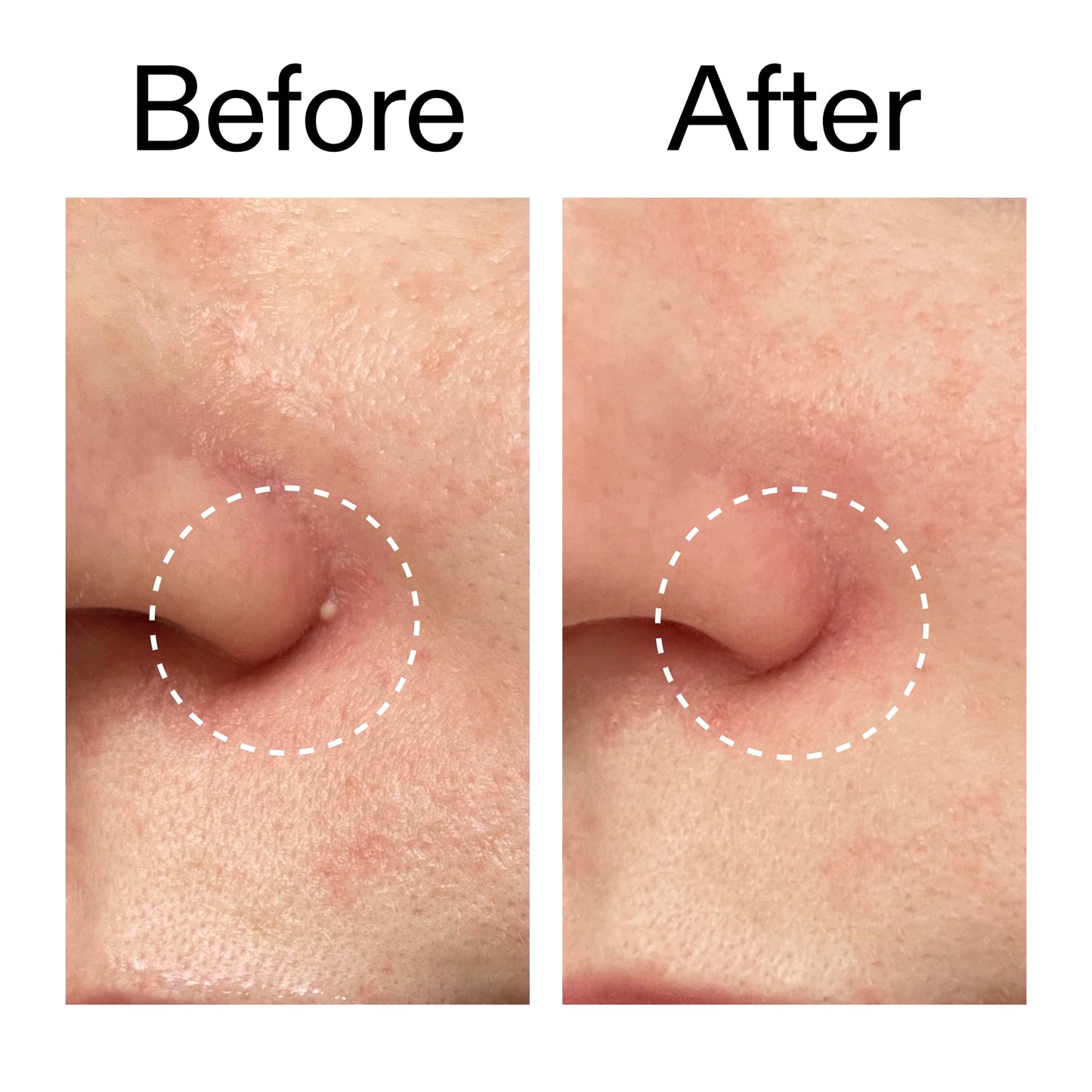 hydrocolloid-invisible-pimple-patches-pack-of-44-w3 Hydrocolloid_Invisible_Pimple_Patches_Before_After_2000x2000_b02aa37b-c78a-4682-91de-9135af5bb7df.jpg
