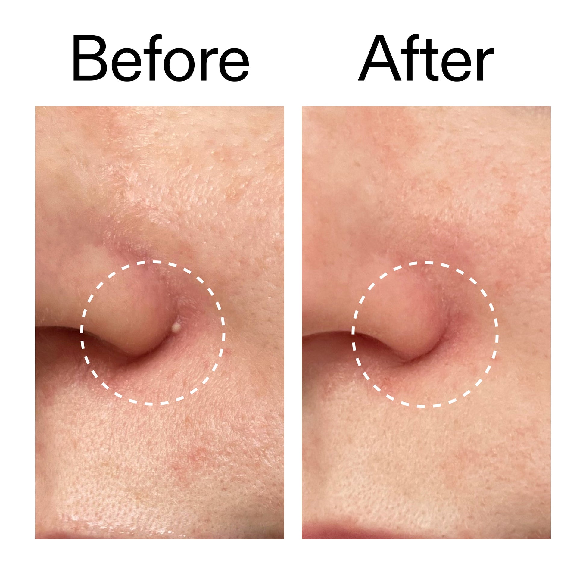 hydrocolloid-invisible-pimple-patches-pack-of-22-g0 Hydrocolloid_Invisible_Pimple_Patches_Before_After_2000x2000_b02aa37b-c78a-4682-91de-9135af5bb7df.jpg