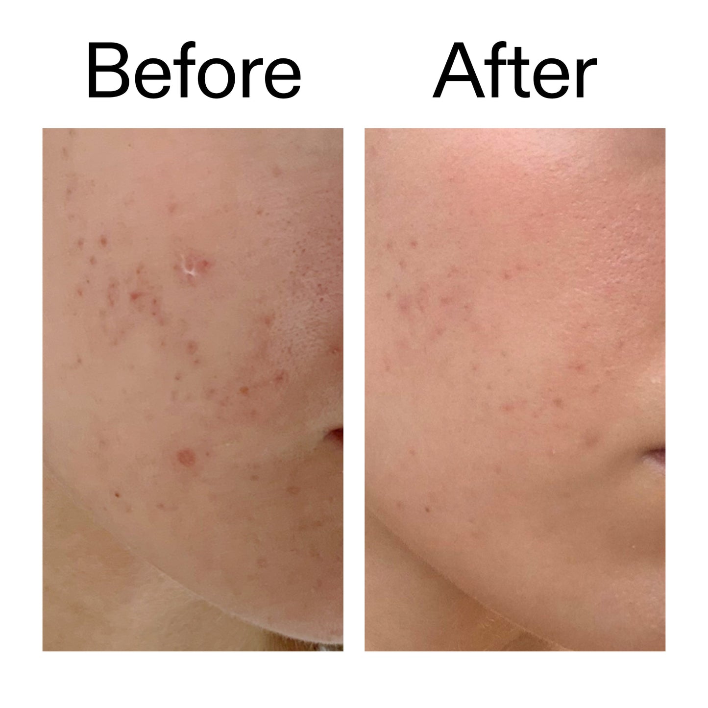 mandelic-acid-treatment-z6 Mandelic_Acid_Treatment_Before_After_2000x2000_4885ac6e-c5d7-4279-a72a-1417af7dce35.jpg