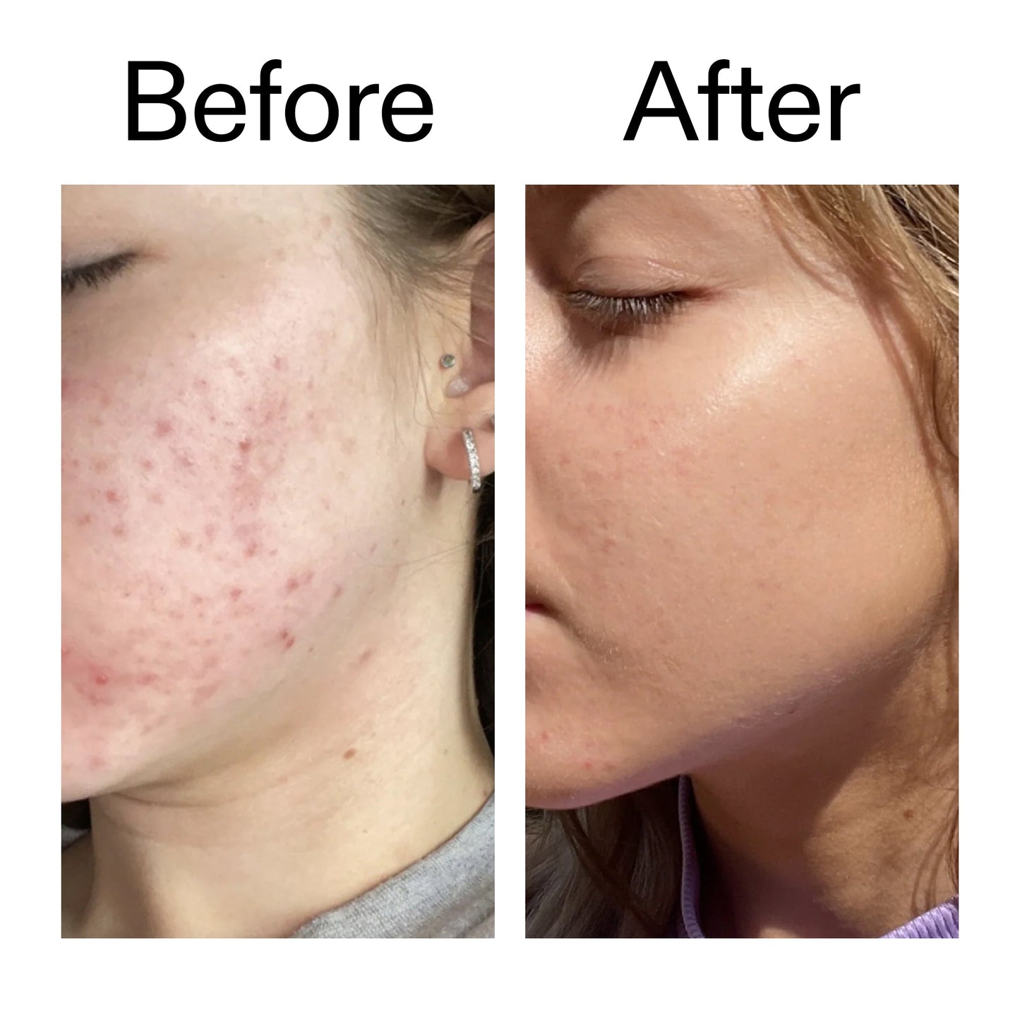 10-niacinamide-serum-duo-w6 Niacinamide_Serum_Before_After_2000x2000_bde32455-9e7d-448e-b053-bef41504f0a9.jpg