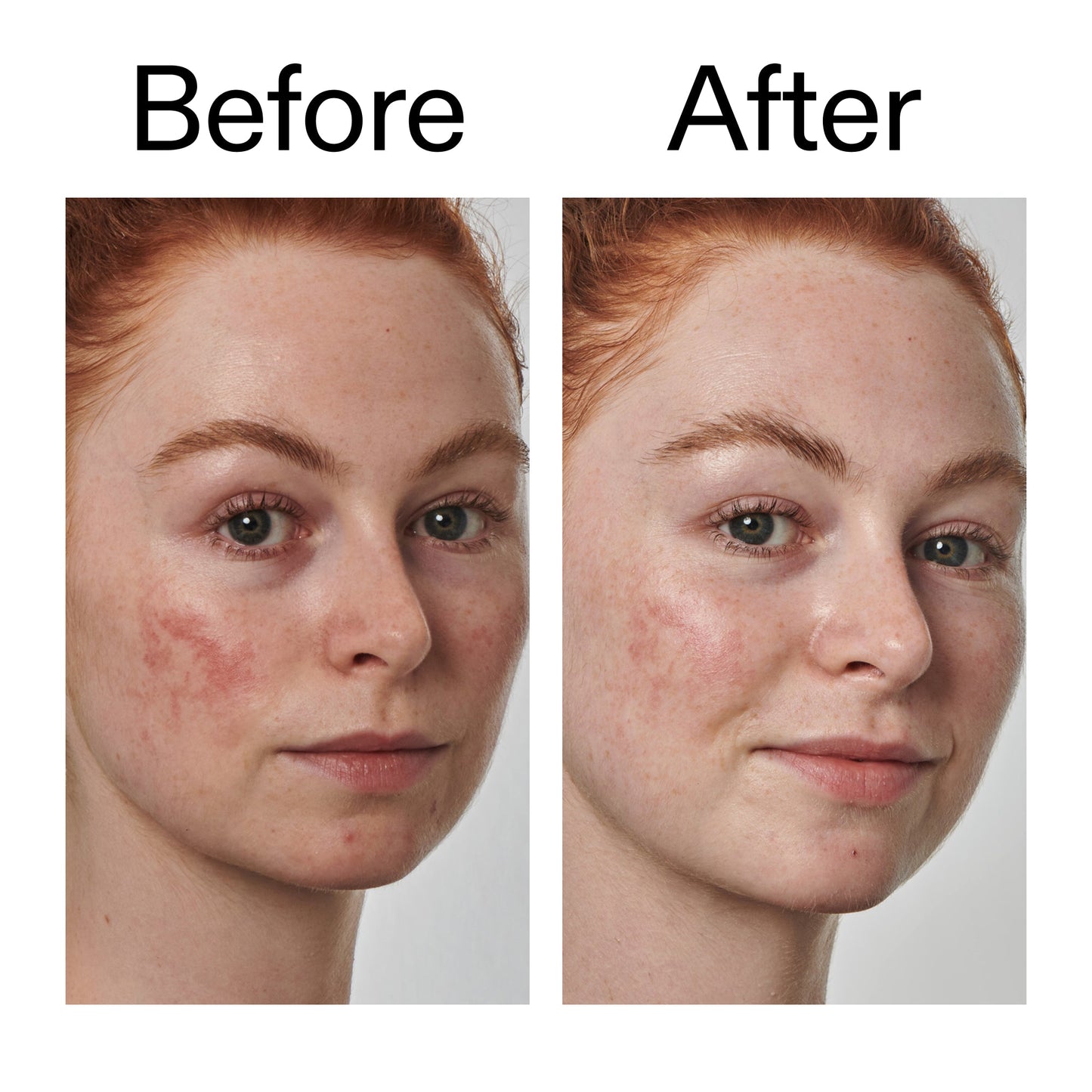 10-azelaic-acid-serum-for-redness-relief-s9 Redness_Relief_Serum_Before_After_2000x2000_3334dc9a-cce9-4e00-8aec-7ad89ca051f2.jpg