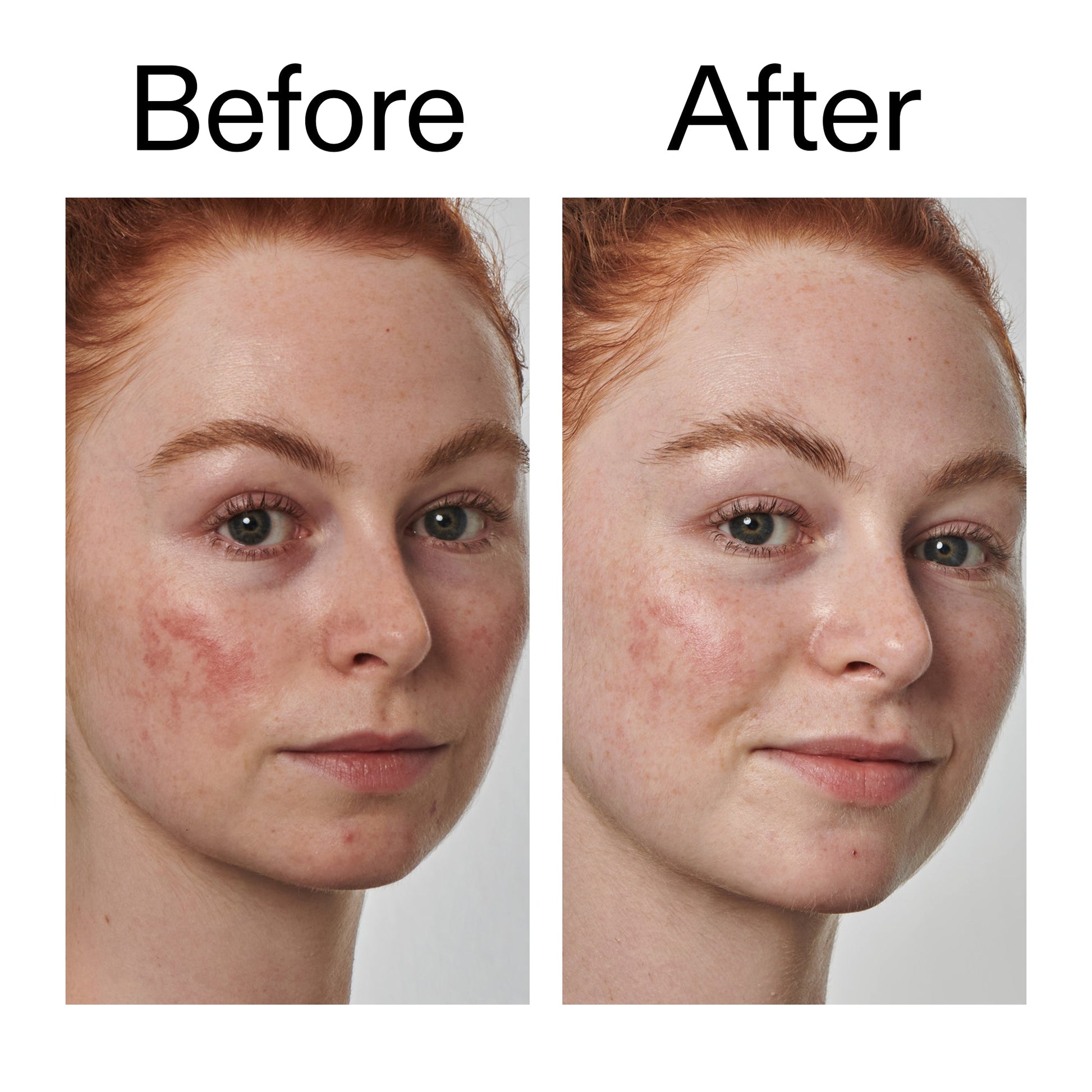 10-azelaic-acid-serum-for-redness-relief-s9 Redness_Relief_Serum_Before_After_2000x2000_3334dc9a-cce9-4e00-8aec-7ad89ca051f2.jpg