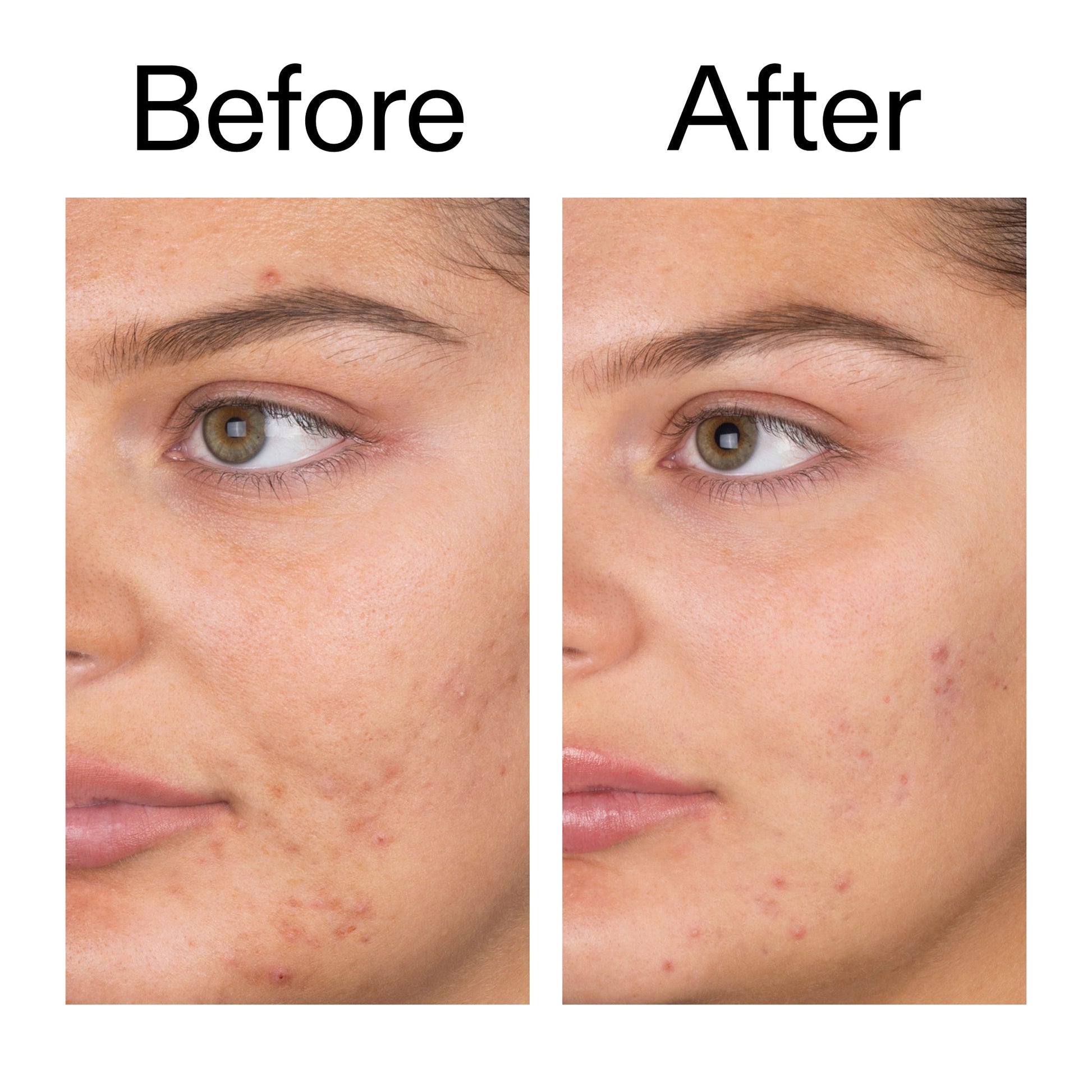 salicylic-acid-cleanser-150ml-w0 Salicylic_Acid_Cleanser_-_150ml_Before_After_2000x2000_e7230494-853f-4b07-82b1-27669104c995.jpg