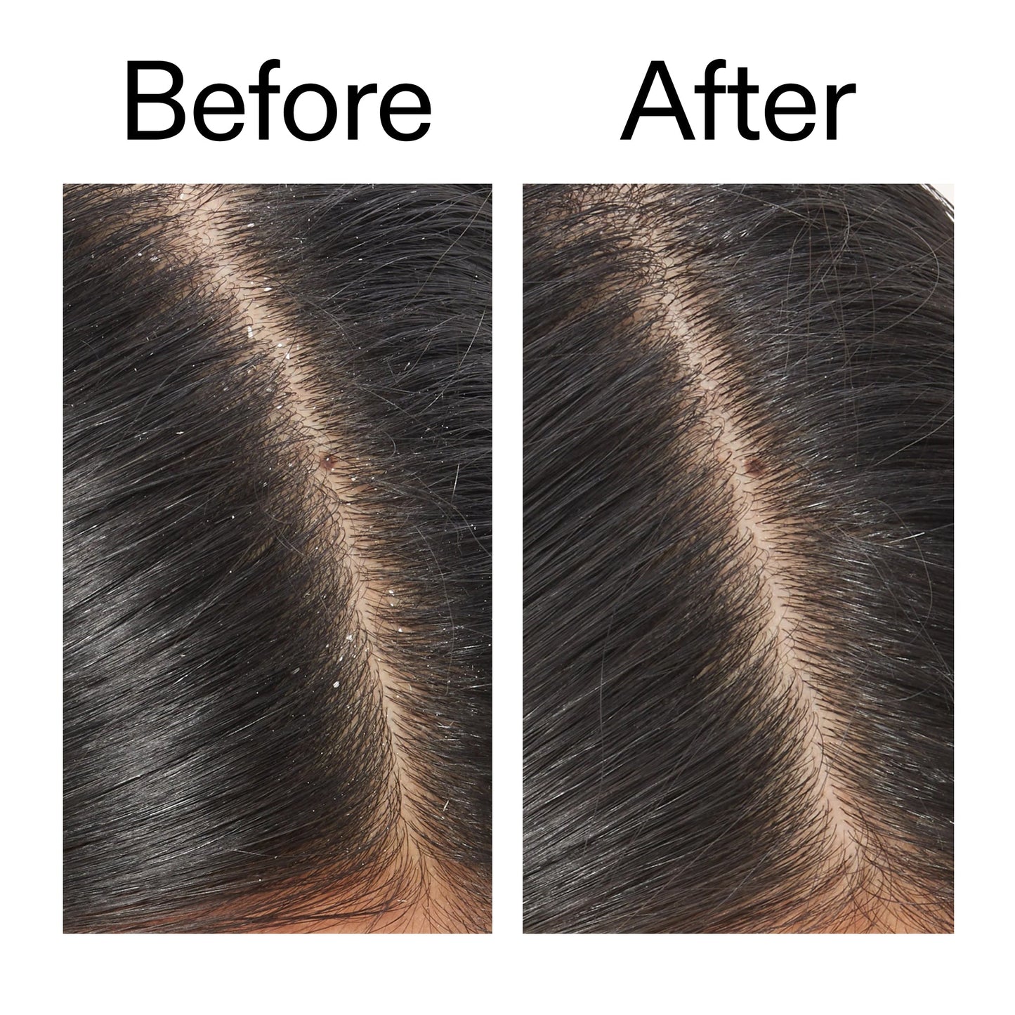 salicylic-acid-exfoliating-scalp-treatment-d7 Salicylic_Acid_Exfoliating_Scalp_Treatment_Before_After_V2_2000x2000_02bd61ad-42bf-490b-b3e3-7e04b2e8a673.jpg
