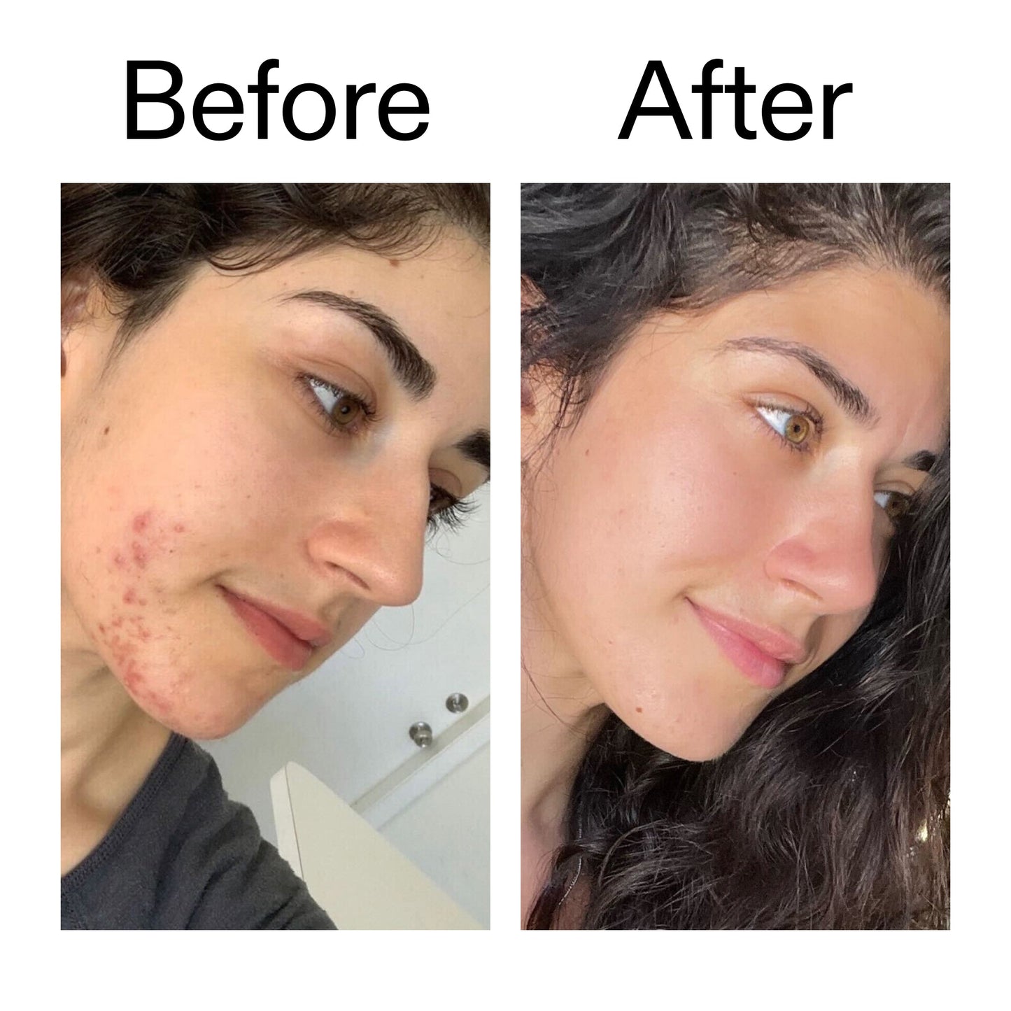 succinic-acid-acne-treatment-y3 Succinic_Acid_Treatment_Before_After_2000x2000_6a5f0054-2f58-4433-9314-0dc72c9bdd3b.jpg
