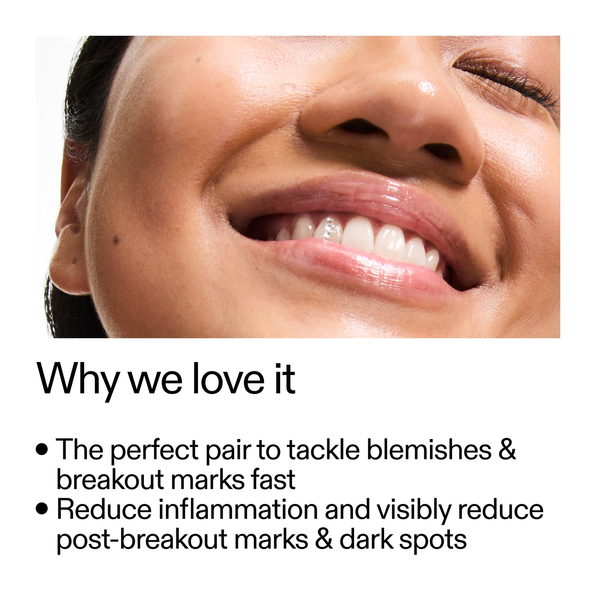 targeted-blemish-duo-q3 Targeted_Blemish_Duo_Why_we_love_it_2000x2000_ff00be46-438b-485f-b5c3-91e60bbb6919.jpg