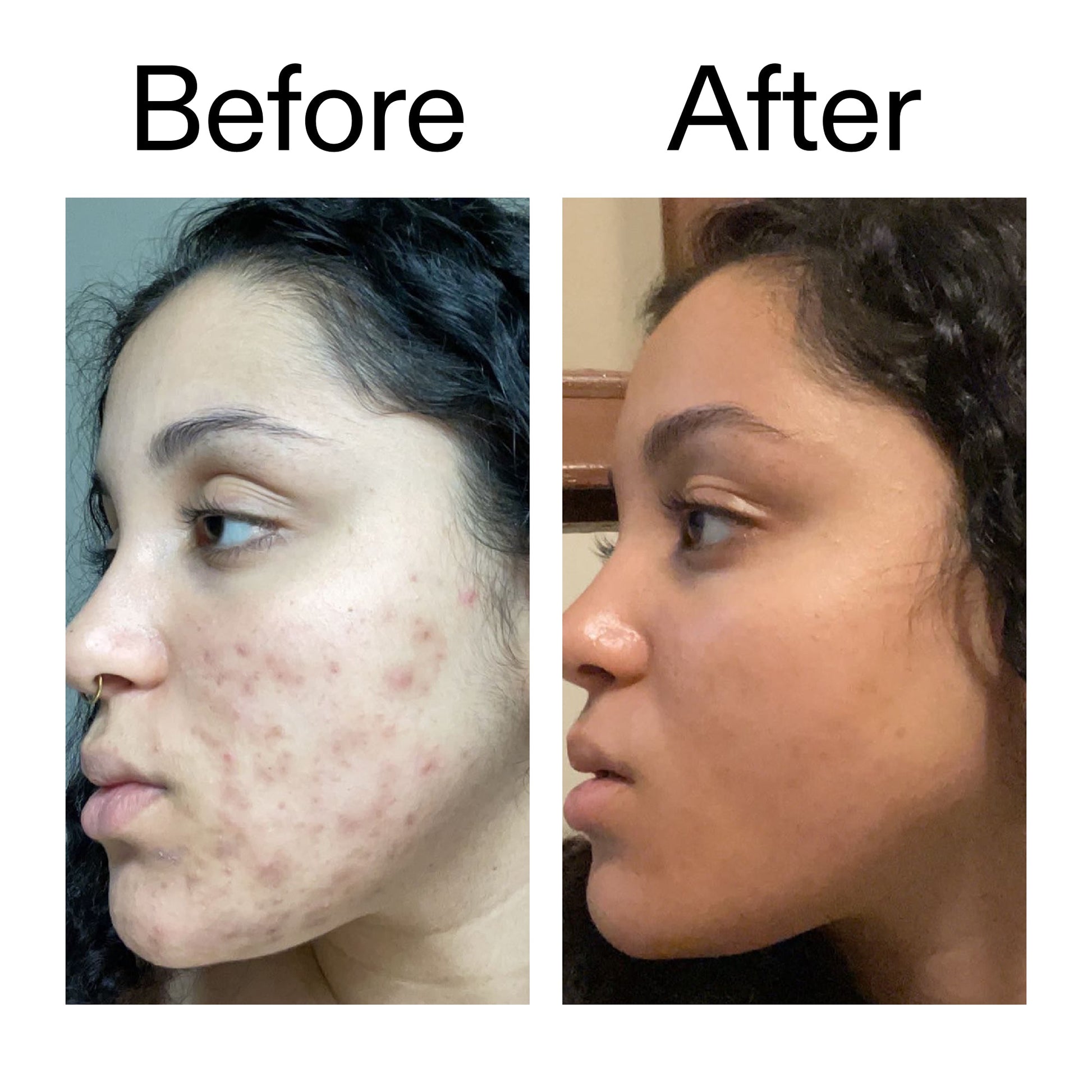 tranexamic-acid-serum-n7 Tranexamic_Acid_Serum_Before_After_2000x2000_98ebc8be-77b0-4843-8a22-90790ebe918b.jpg
